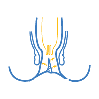 Anal fissure