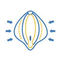 Labioplasty