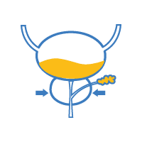 TURP (Prostatectomy)