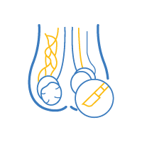 Varicocele